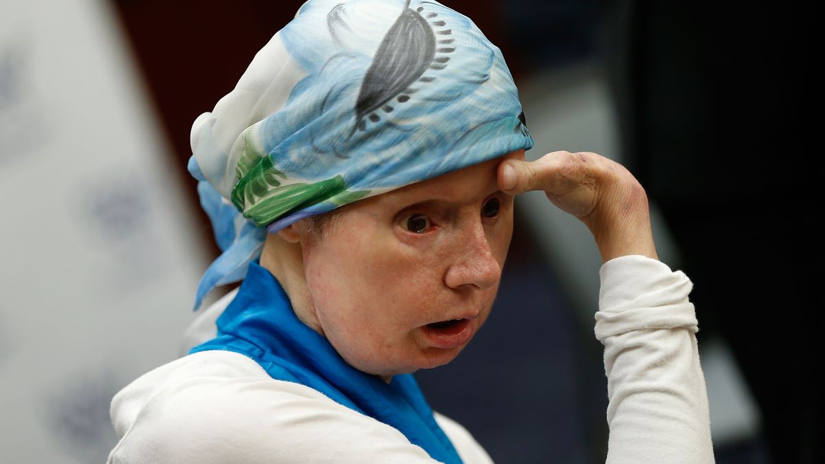 harla Nash, the victim of a mauling by a pet chimp in Connecticut in 2009 and who underwent a face transplant, speaks at a press conference July 10, 2014 on Capitol Hill in Washington, DC. Nash joined members of Congress in advocating for changes in federal law banning the interstate trade of primates. (Photo by Win McNamee/Getty Images)