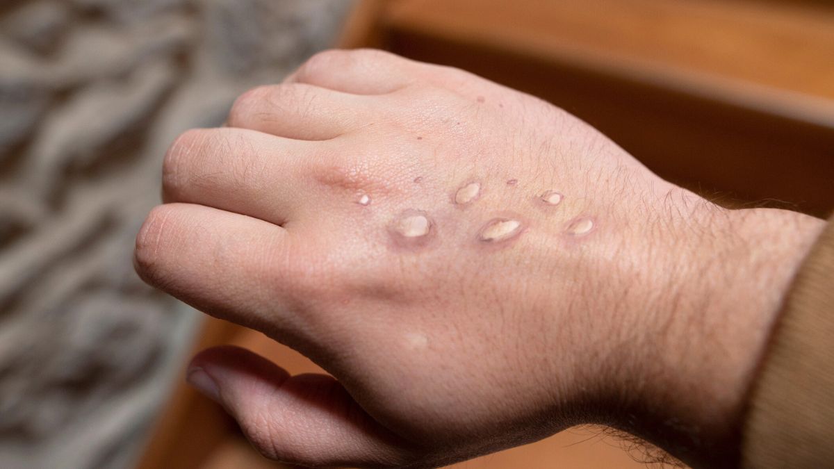 Monkey pox vesicles in a hand